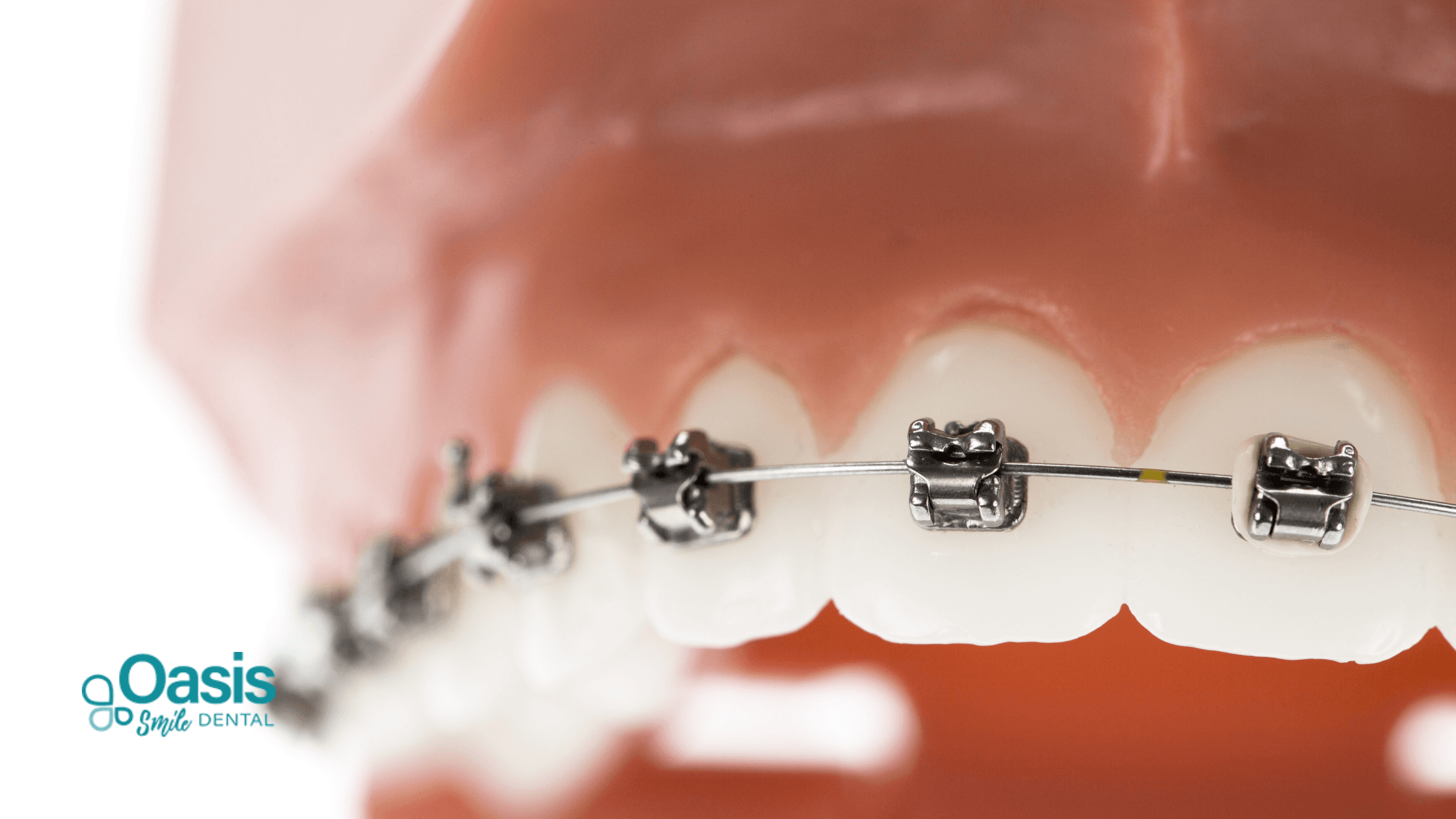 Why Dental Checkups Are Crucial During Orthodontics