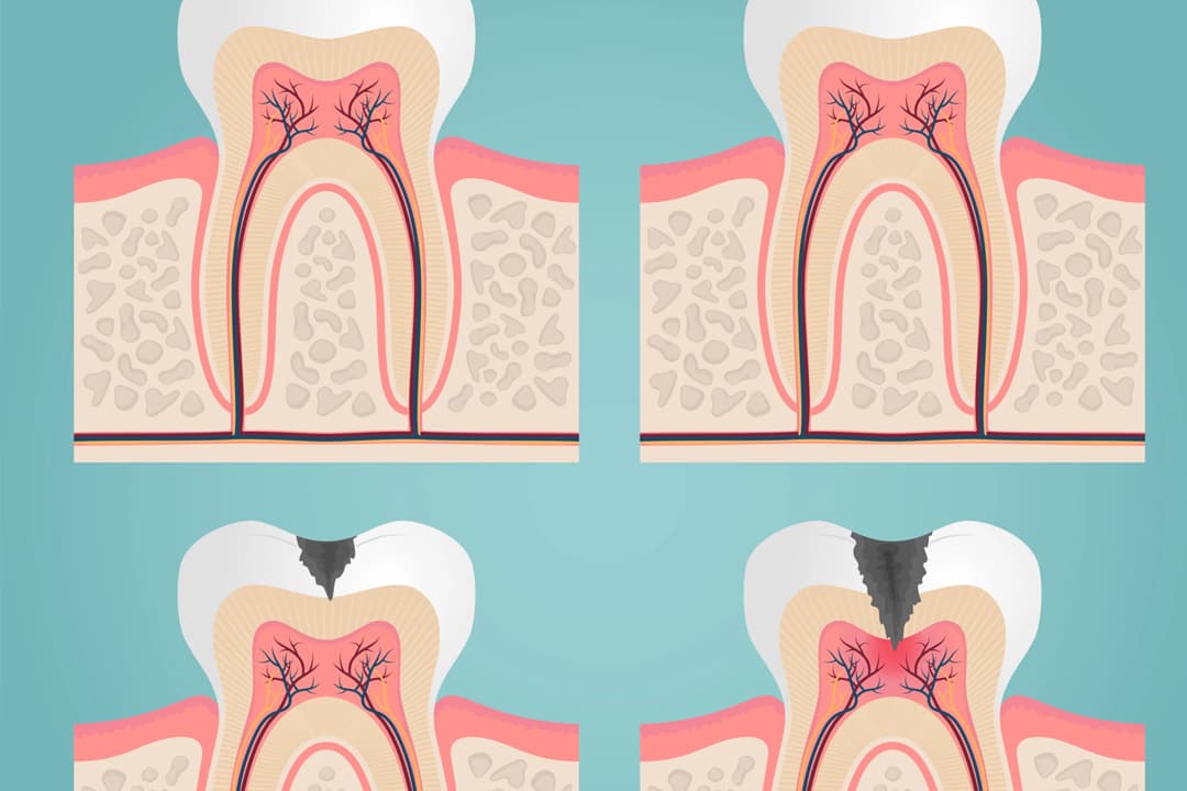 What is Throbbing Tooth Pain?