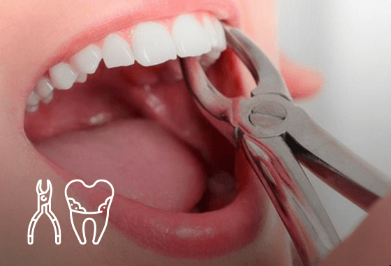 Tooth Extraction